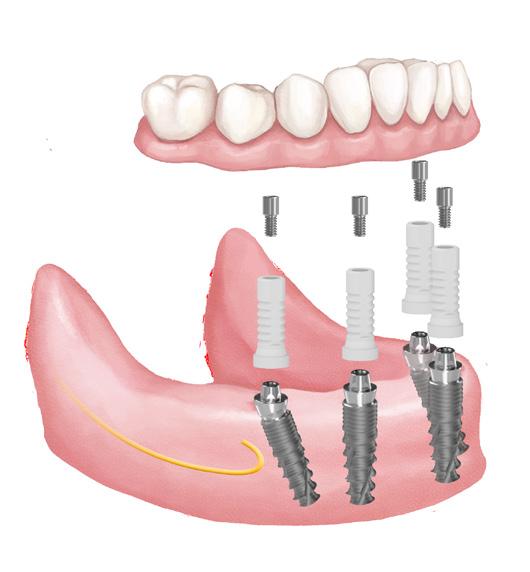 A dönthető hátsó implantátumokat jobban lehet rögzíteni az elülső csontba. Ez elősegíti a protézis alátámasztását.