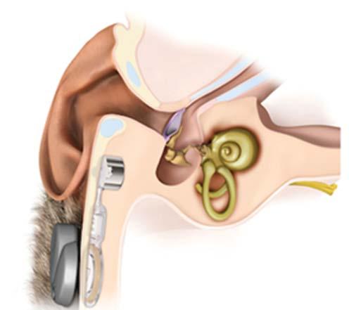 5. ábra: Bonebridge implantátum processzorral 7. ábra: Vibrant Soundbridge implant 6. ábra: Bonebridge implantáció a Heim Pál Gyermekkórházban (4. ábra).