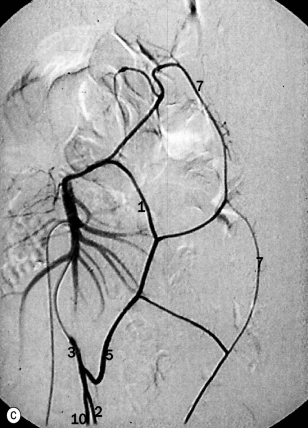 Árkádszerű (end-to to-end) anasztomózisok zisok az arteria mesenterica superior és s inferior ágrendszere között k a