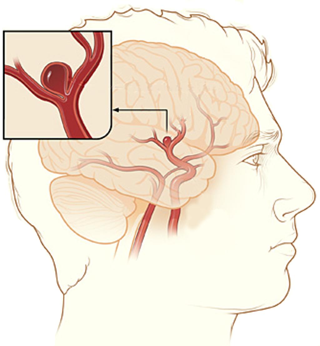 1 BEVEZETŐ A jelen dolgozatban bemutatott kutatások fo témája az emberi agyi artériás hálózat egy kóros állapota, ami agyi aneurysma néven ismert.