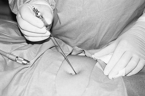 A laparoscopia eszközei, formái