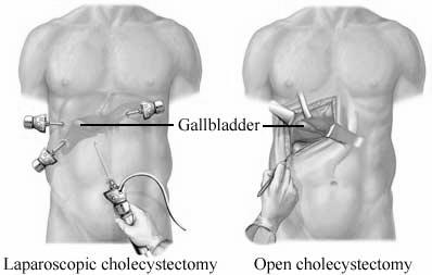 1. Cholecystectomia A leggyakoribb