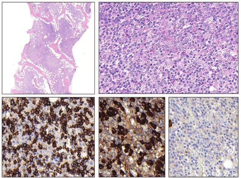 A WALDENSTRÖM-MAKROGLOBULINÉMIA PATOLÓGIÁJA 9 HE, 2X HE, 40X CD20 kappa lambda 2. ÁBRA. Limfoplazmocitás limfóma csontvelő-érintettsége a releváns immunhisztokémiai vizsgálatokkal.