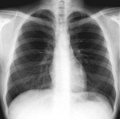 A mellkas és a mellüregi szervek antero-posterior irányú röntgenfelvétele Trachea Apex pulmonis dextri Apex pulmonis sinistri V.