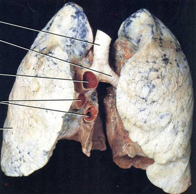 Trachea, bifurcatio tracheae, bronchi principales, pulmones aspectus anterior Trachea Facies mediastinalis Apex pulmonis Bronchus