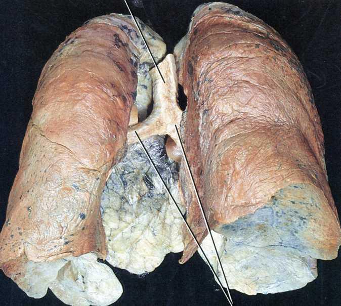 Trachea, bifurcatio tracheae, bronchi principales, pulmones aspectus posterior Trachea, paries membranaceus Pulmo sinister