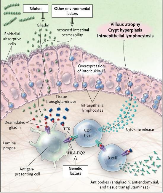 COELIAKIA PATHOGENESISE GLIADIN ZONULIN ttg TIGHT JUNCTION DISRUPTIO LEAKY GUT DEAMIDÁLT GLIADIN ANTIGÉN PREZENTÁLÓ SEJTEK (APC) HLA-DQ2 / HLA-DQ8 CD4 + T-LYMPHOCYTÁK citokinek B-LYMPHOCYTÁK IgA >