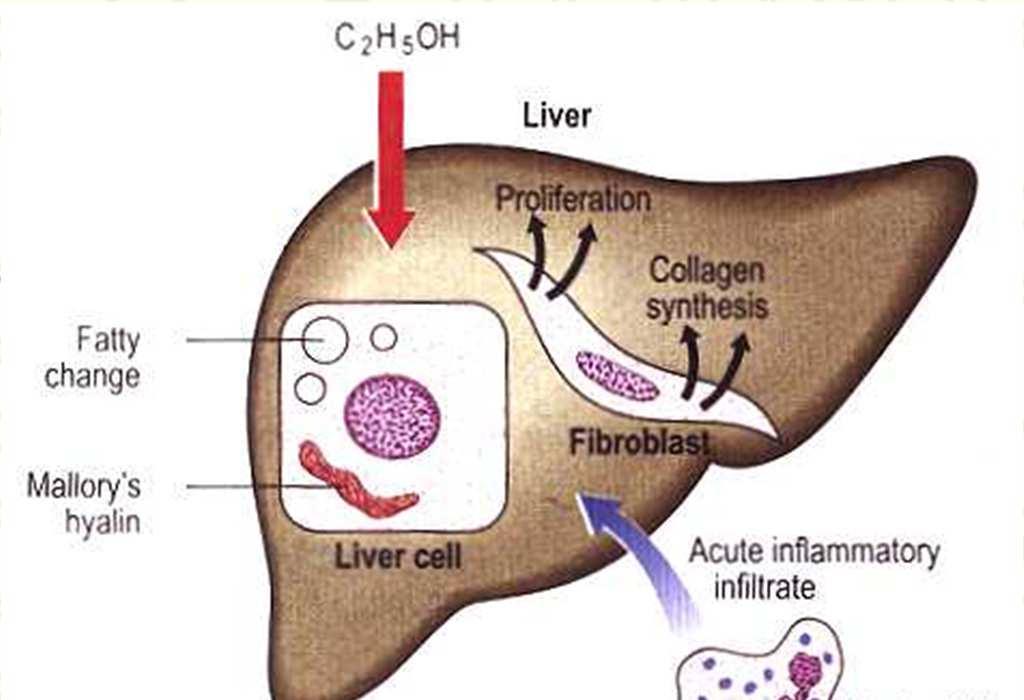 Alkoholos májkárosodás Acetaldehid az alkohol hepatotoxikus metabolitja.