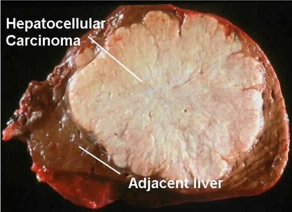 Hepatocelluláris karcinóma Hepatikus tömörülés: aszcitesz Tumormarkerek Alfa-fötoprotein