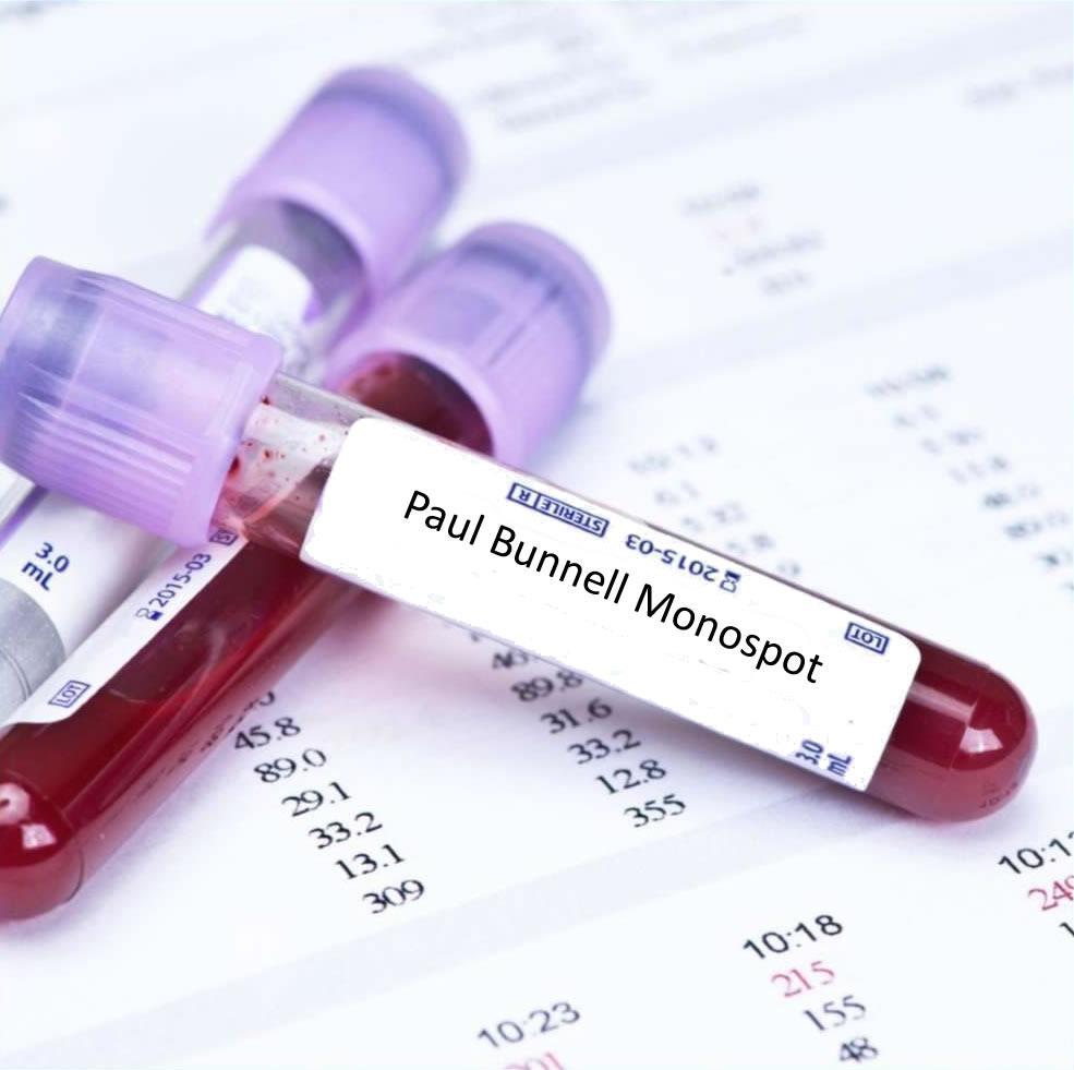 Paul-Bunnell reakció Mononucleosis infectiosa esetén EBV: P-B