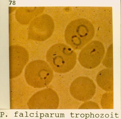 falciparum