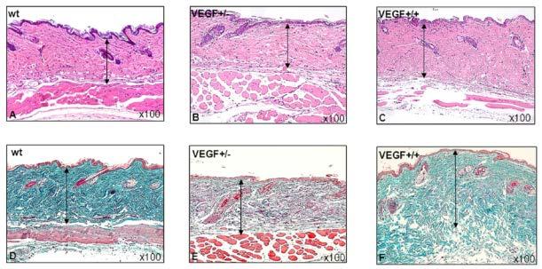 VEGF -----FIBROSIS.