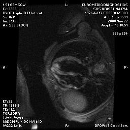 Endomyocardialis biopszia Terapia: steroid, IVIG AT