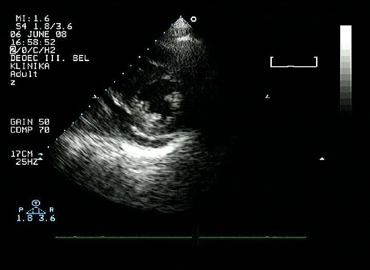 Echocardiographia MR Endomyocardialis biopszia