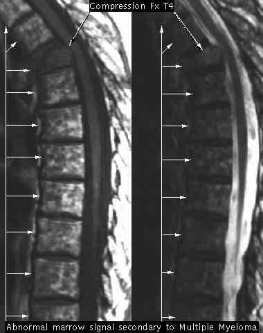 MRI of MM