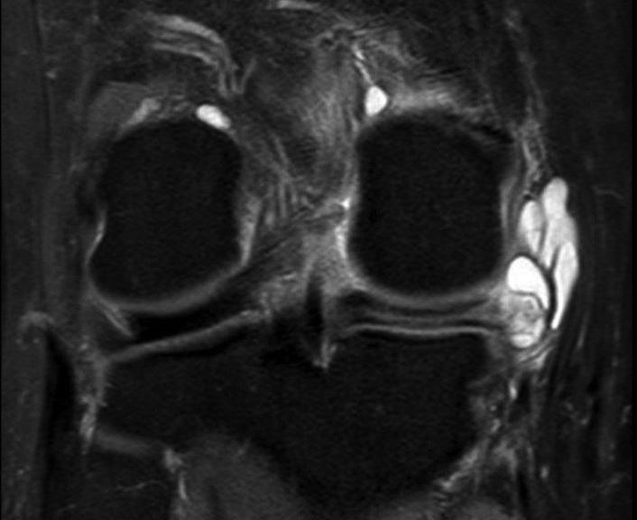 A hátsó keresztszalag eredése mögött kis körülírt intraarticularis ganglion ciszta