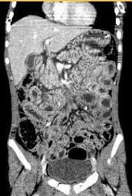 HASI SÉRÜLÉSEK Hypoperfusion complex ( shock abdomen ) Gyermekkori jellegzetesség. Hypovolémia kompenzációjaként fellépő szimpatikus stimuláció okozza.