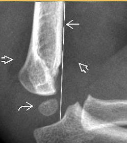 VÉGTAGI TÖRÉSEK Supracondyler humerus-törés (Gartland) Extensiós (95%) vagy flexiós