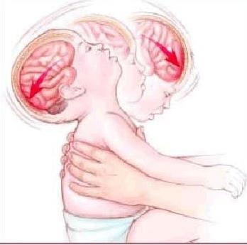 KOPONYASÉRÜLÉS Bántalmazott gyermek 1. Direkt ütés: impressiós koponyatörés, közvetlenül alatta agyi contusio. 2. Megrázott baba: diffus subduralis haematoma.