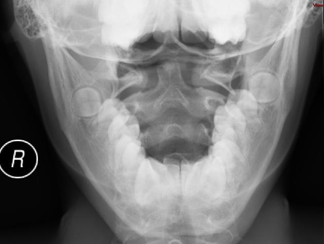 CERVICALIS GERINC SÉRÜLÉSEI Lateralis atlantodentalis távolságban 5 mm aszimmetria még normális. Pseudosubluxatio: CIII Csigolyához képest a CII előrébb lehet 5 éves korig.