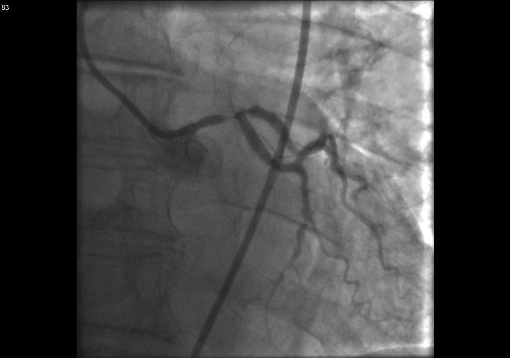 LM PCI Clinical Application Single 2.75 mm stent placed Figure 1 Figure 2 Post Dilatation: 3.
