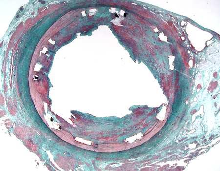 Coronary Arteries. Am J. Cardiology; March 1, 1998: vol. 81, :552-557 2.Moussa, Moses, Columbo et al.