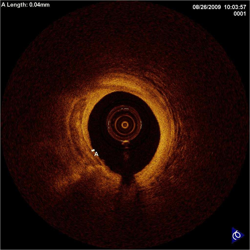 After Rotablator Atherectomy After