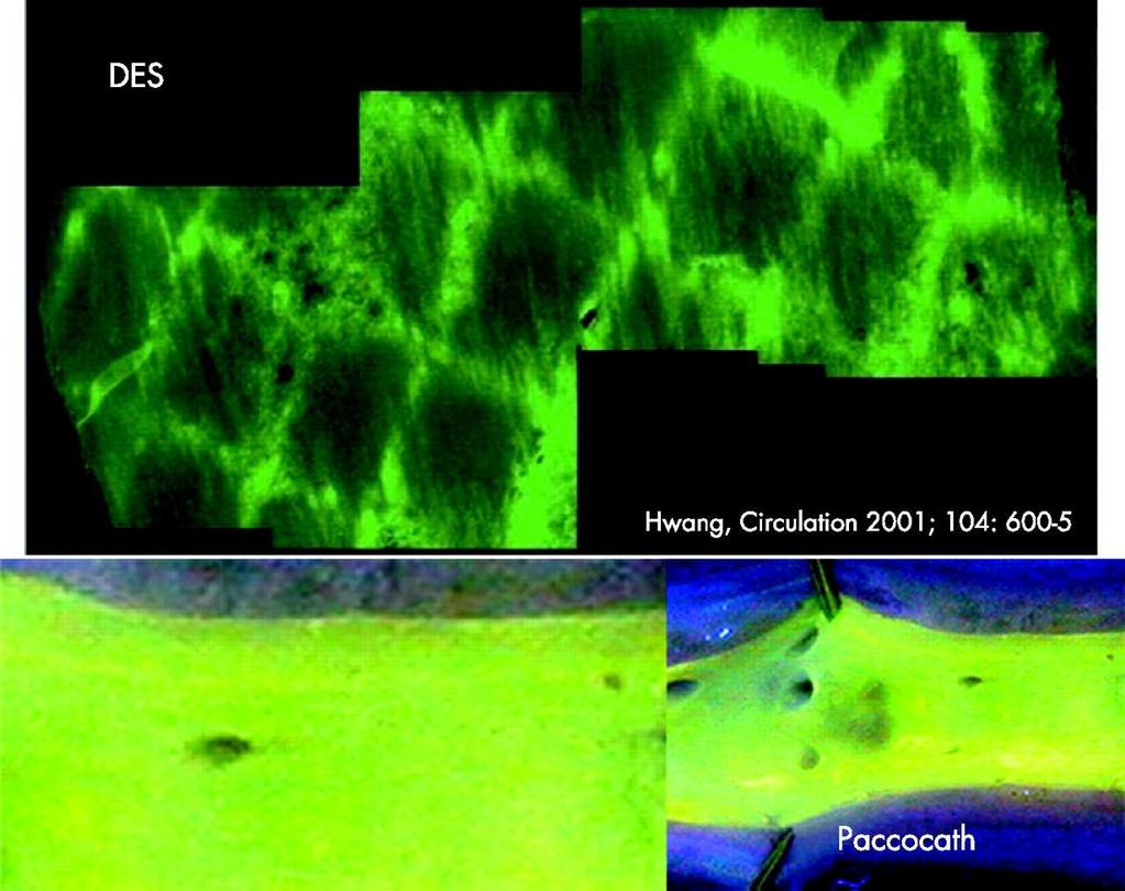 Figure 1 Inhomogeneous drug distribution from luminal surface after implantation of a drugeluting stent (DES) (reprinted with permission from Hwang CW, Wu D, Edelman ER.