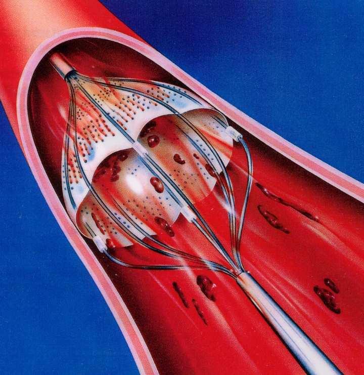 calcified lesions that cannot be crossed by a balloon or adequately dilated before planned stenting De nova ostial or