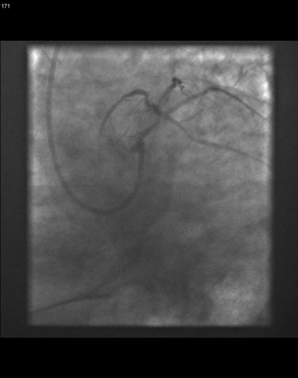 ballon/két ballon/1 stent+ballon, 2 stentes technikák) Meszes szűkület