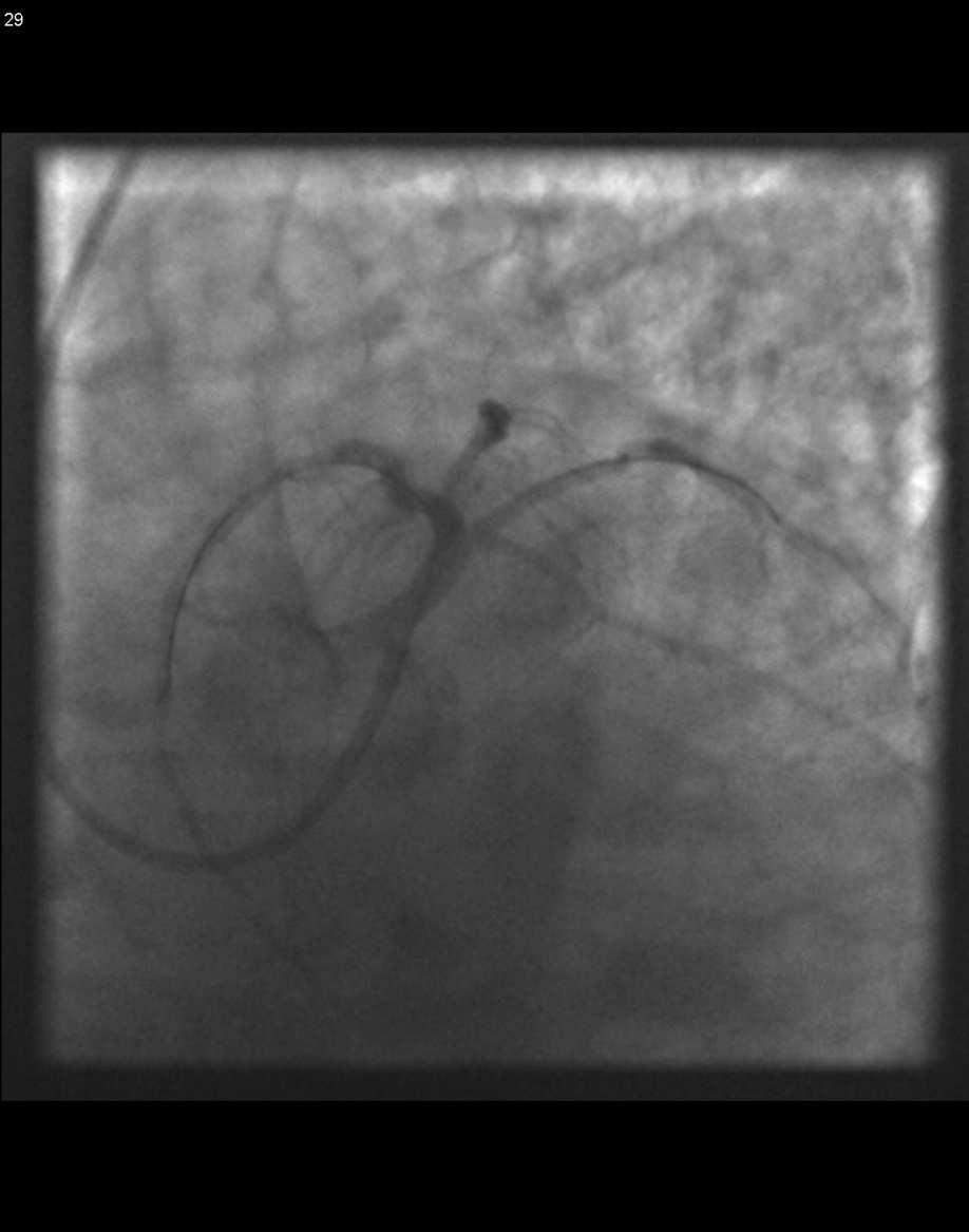 restenosisok (DES, DEB) Non compliance betegek (anti-thrombotikus