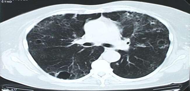 Computer tomográfia Spirál CT Pulmonális CT