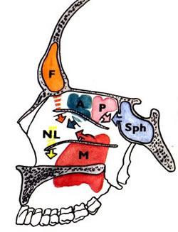 Meatus nasi medius (Hiatus semilunaris) M: Sinus maxillaris Meatus nasi medius (Hiatus