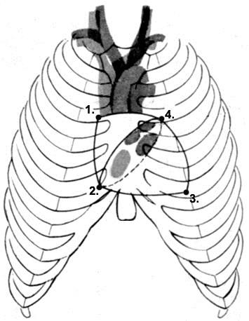 1. v. cava superior (jobb 3. bordaporc szegycsonti végénél) aortabillentyű, jobb 2. bordaköz 2.
