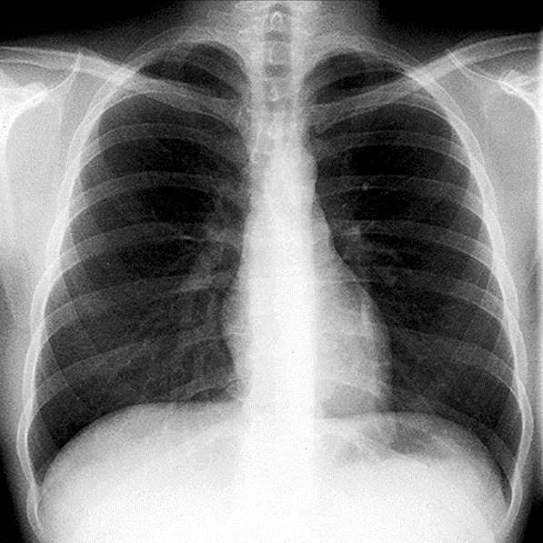 A szív röntgenárnyéka