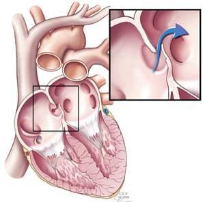 septum secundum septum secundum foramen secundum