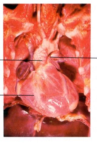 Fejlődési rendellenességek Dextrocardia Kamrai