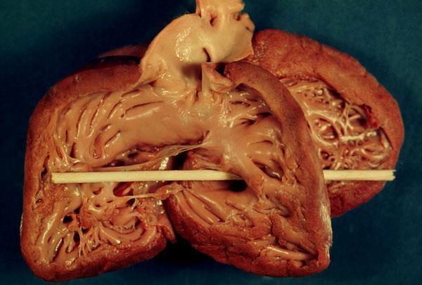 pulmonaris stenosis 2. Kamrai septumdefektus 3.