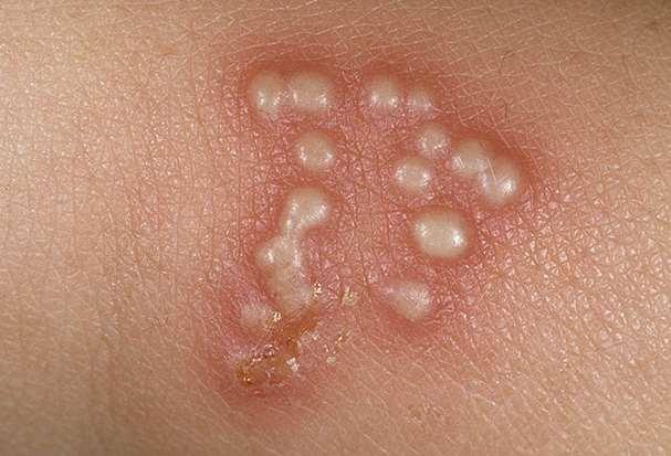 erythema Duzzanat,