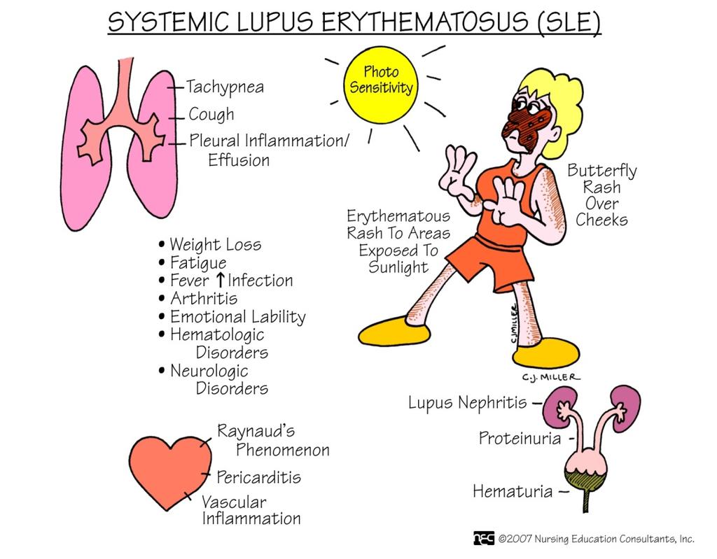 Szisztémás lupus erythematosus (SLE) Krónikus, szisztémás, autoimmun betegség; a nagyfokú autoellenanyag termelés immunkomplexek precipitálódnak a szövetekben kiterjedt destrukció Előfordulása