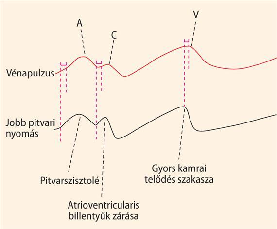 jugularis externán regisztrált térfogatváltozás (vénapulzus), az alsó (fekete) görbén a jobb pitvar nyomásingadozásai láthatók.