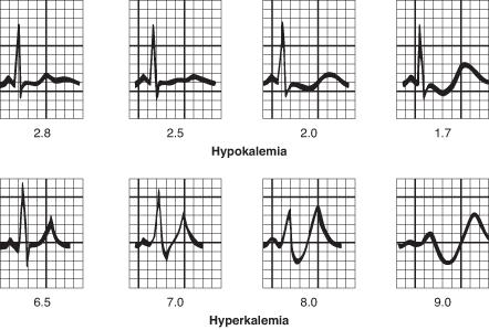 Bainbridge-reflex / sinus arrhythmia Belégzés mellűri nyomás csökken vénás visszaáramlás nő pitvari feszítési receptorok aktiválódnak nyúltvelői vegetatív kp.