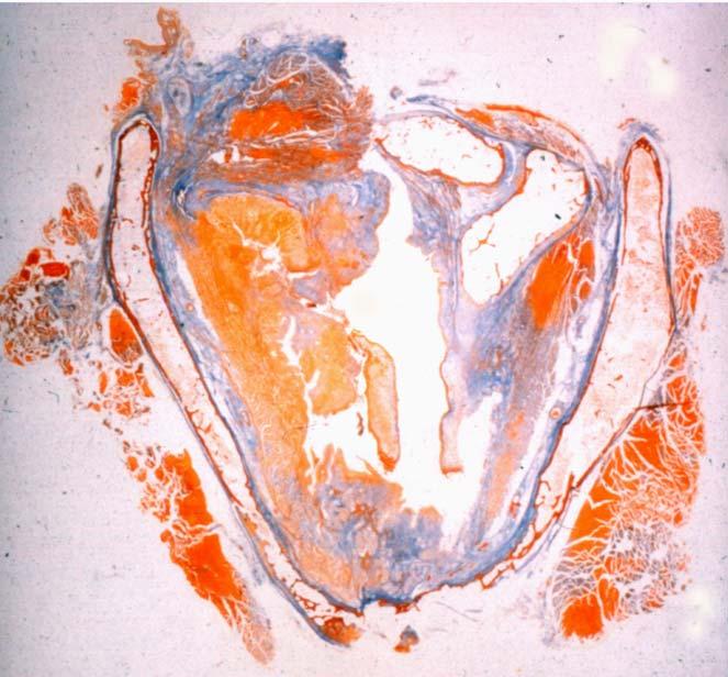 3. Eredmények 3.1. A CD44v3, v6, NM23H1 és az MMP2 expressziója fejnyaki daganatokban 15 laryngealis és hypopharyngealis tumoros mintát szerepelt tanulmányunkban (1. táblázat).