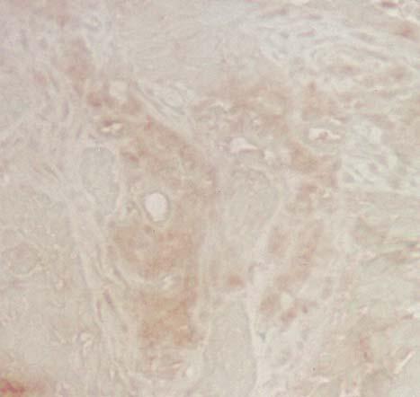Az MMP2 fehérjét csak ritkán sikerült azonosítanunk a daganatsejtekben és az főleg az elszarusodó laphámsejt fészkek sejtjeinek citoplazmájára lokalizálódott