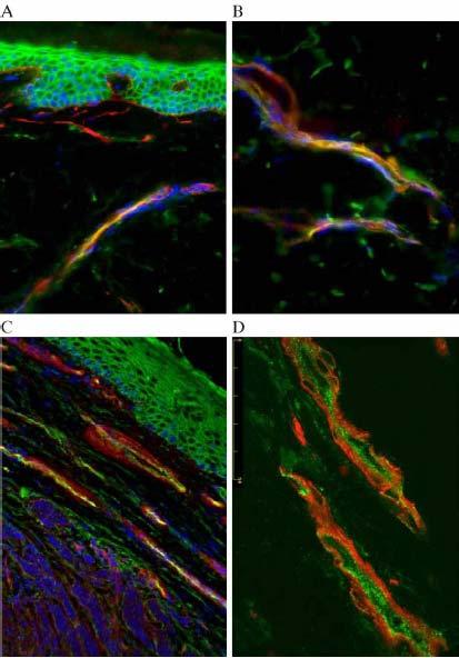 20. ábra. Immunfluoreszcens mikroszkópia: peritumorális mikroerek CD44v3 és laminin kettősjelölése melanoma malignumban (A, B) és fejnyaki tumorokban (C, D).