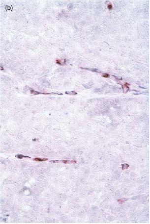 24. ábra. Peri- és intratumorális erek immunhisztokémiája malignus melanomában. (a) peritumorális mikroerek, (b) intratumorális mikroerek.