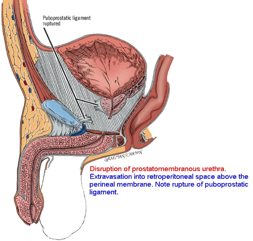Urethra masculina sérülése
