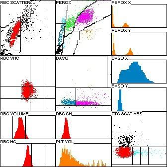 Hematológia Vérkép (mennyiségi + minőségi + retikulocyta) Fehérvérsejtszám (WBC) 15,7 G/l 6,0-16,0 G/l Neutrophil granulocyta szám 11,6 G/l + 3,0-11,5 G/l Lymphocyta szám 1,5 G/l