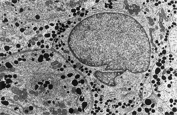 Mammosomatotroph adenomák (monocellulárisak) Egyféle sejt termeli a PRL-t és GH-t Változatos méretű, heterogén granulumok, granuláris