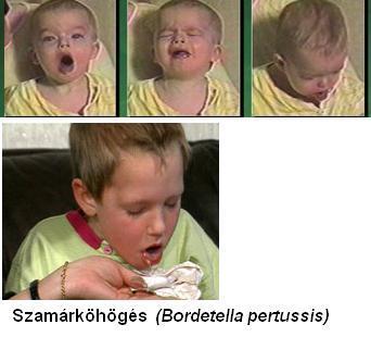 Pertussis